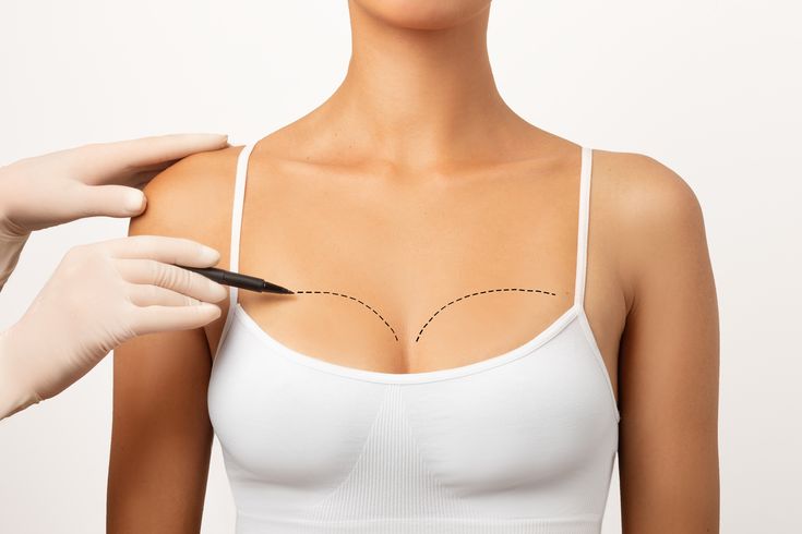 Breast Augmentation Guide – Learn What to Expect